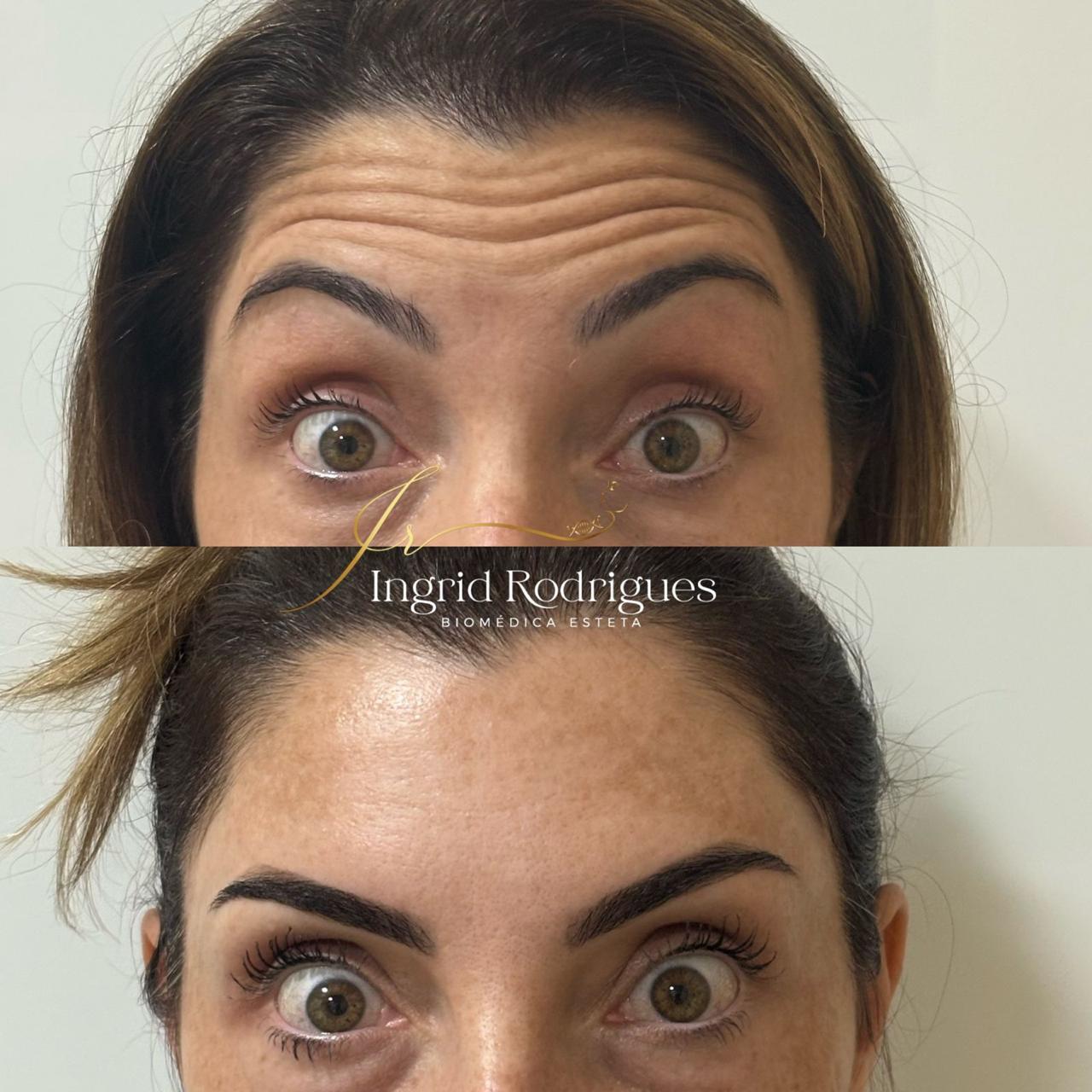 Toxina Botulínica (Botox)