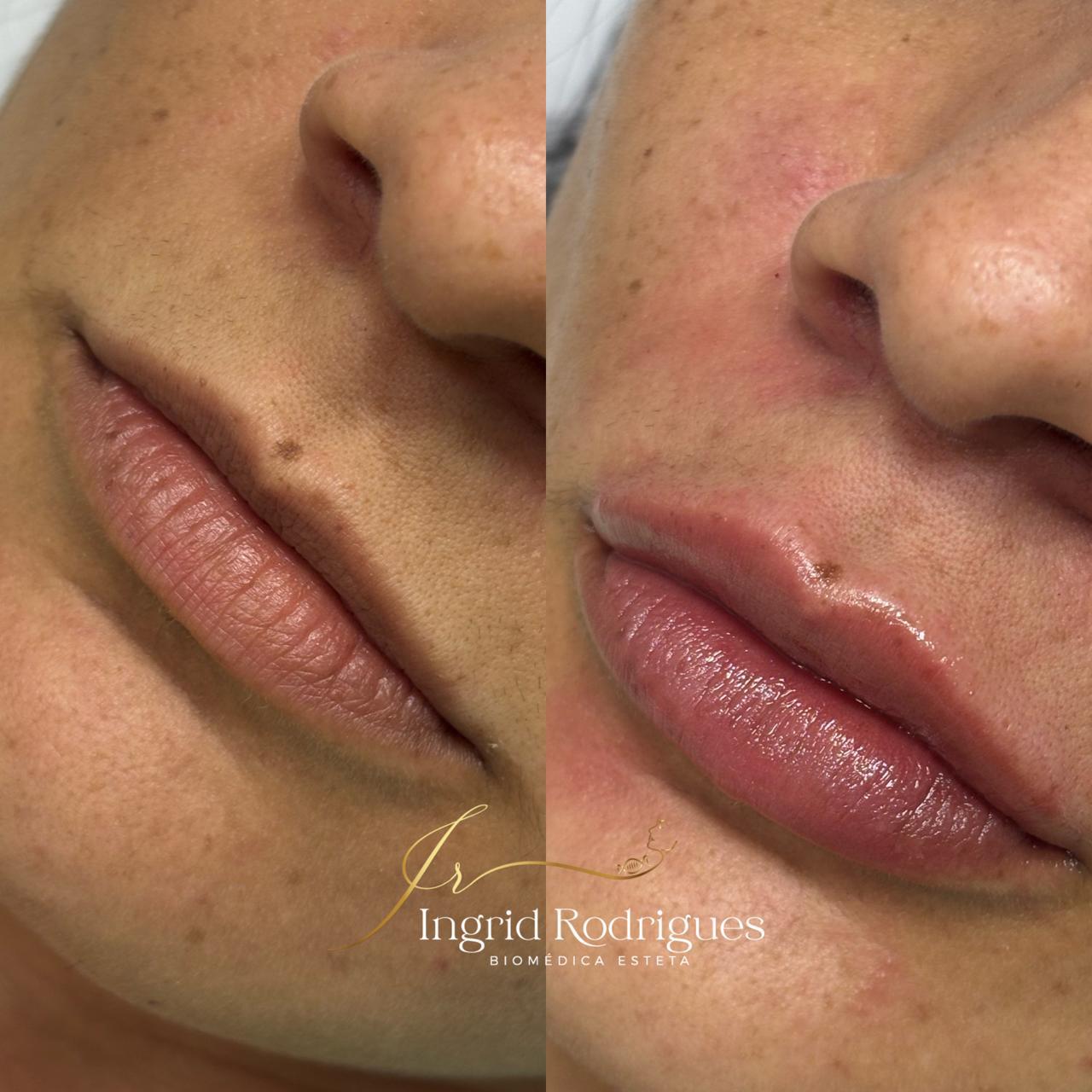 Preenchimento Labial